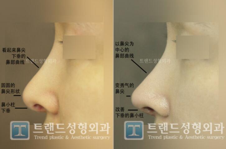 长鼻修复术后效果对比