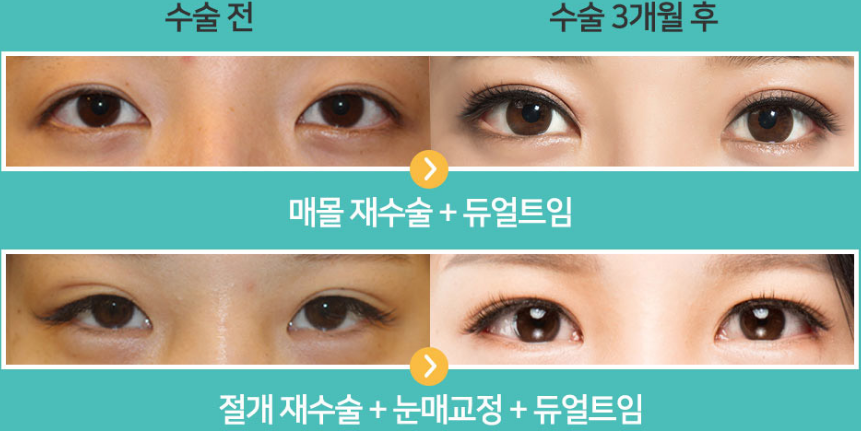 韩国奥斯卡双眼皮案例