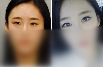 id整形外科双眼皮案例对比