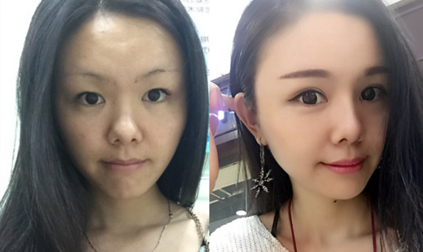 韩国碧夏整形外科眼鼻整形对比案例