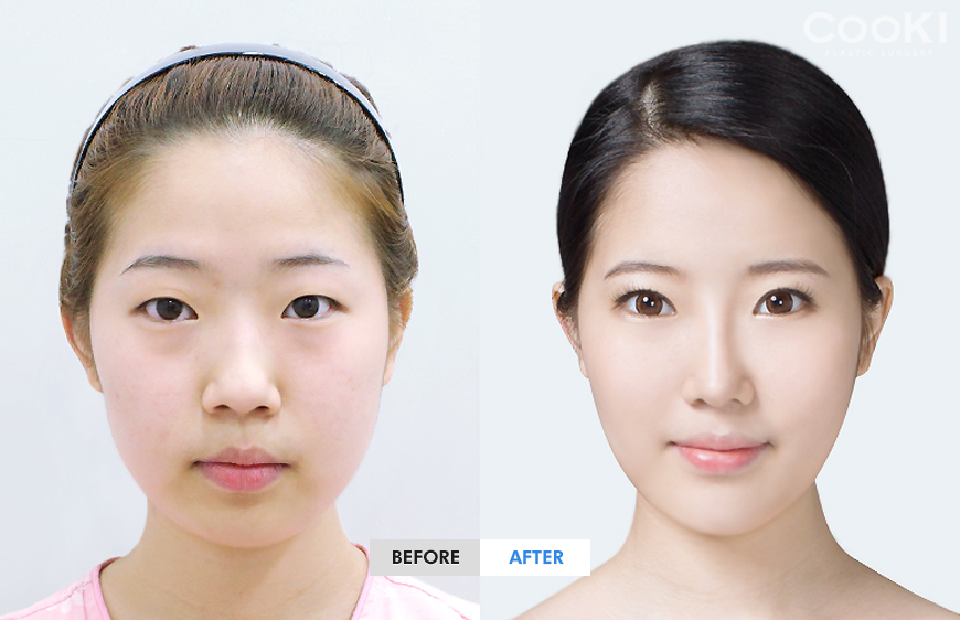 韩国cooki整形外科双眼皮整形对比案例