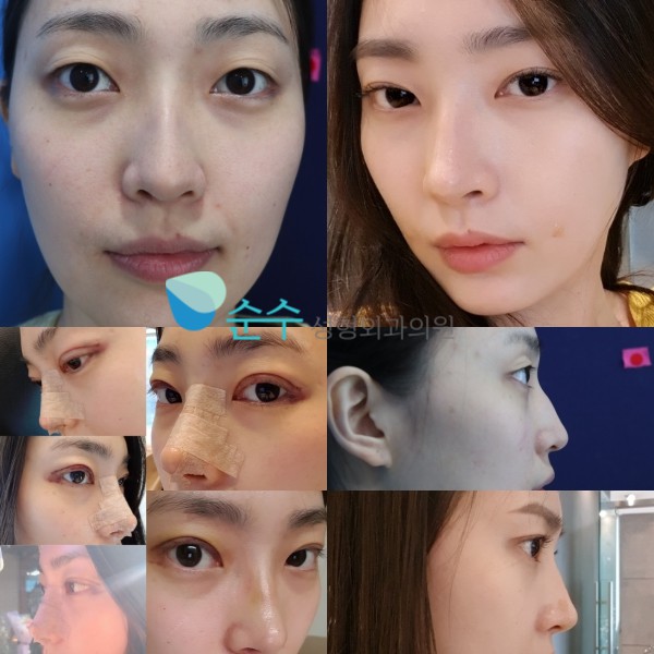 韩国纯真整形外科双眼皮整形对比案例