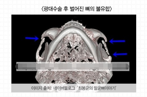 韩国cbk面部轮廓颧骨缩小手术图