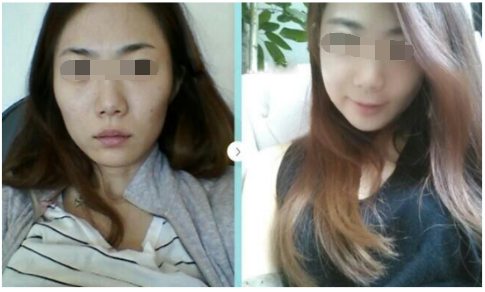 韩国cbk整形外科颧骨+面部轮廓前后对比照片