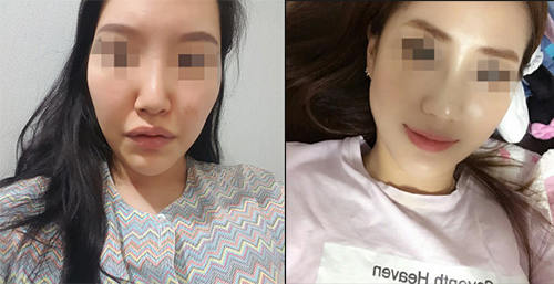 韩国cbk整形医院网红轮廓三件套手术案例图