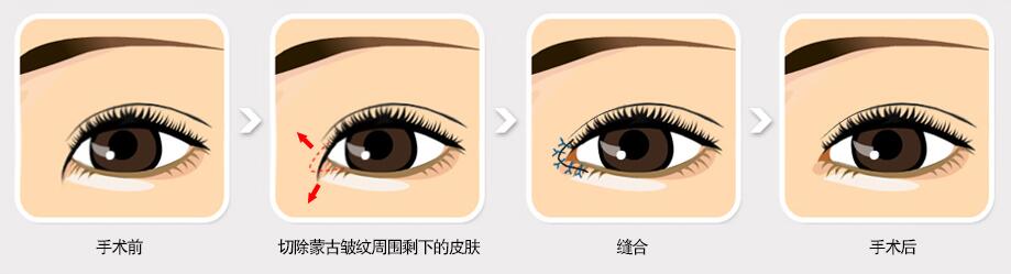 眼角修复手术方法