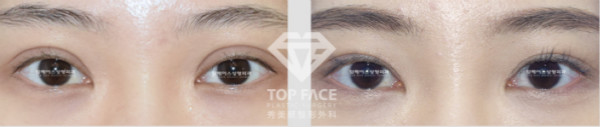 双眼皮修复手术案例图