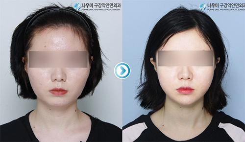 韩国now美颧骨缩小手术案例图片展示