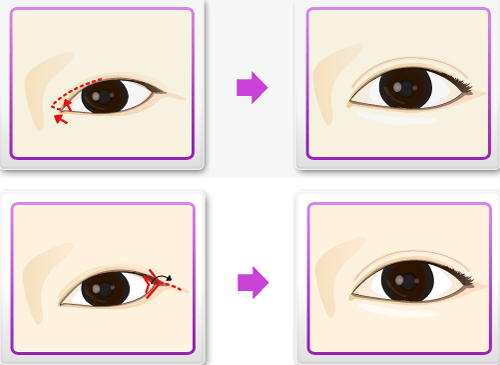 眼睛上睑下垂能开眼角吗，手术应该怎么做？