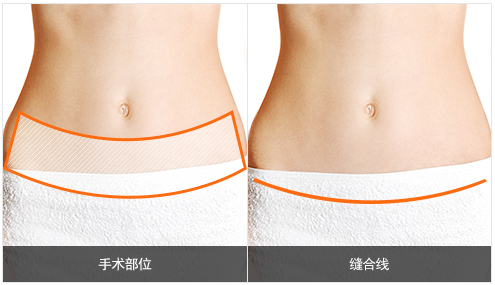 在韩国做一次腹壁整形需要多少钱