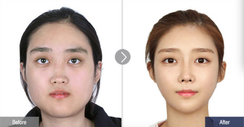face-line下颌角手术案例对比图