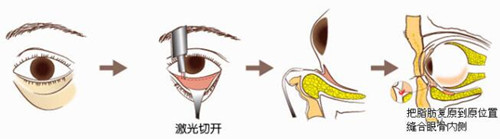 韩国ACE激光祛除眼袋手术方法