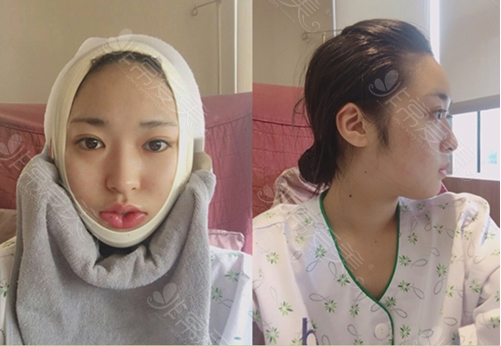 韩国ID医院下颌角缩小术恢复效果