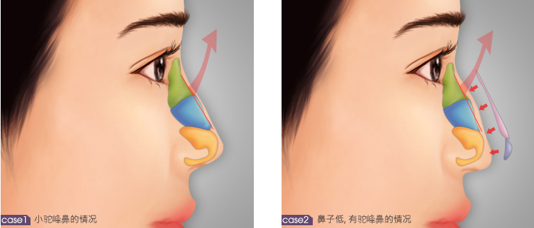 韩国驼峰鼻矫正手术示意图