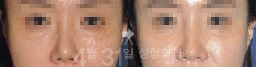 韩国4月31日歪鼻矫正手术对比案例