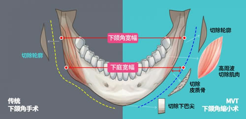 韩国ID整形外科轮廓手术特点分析