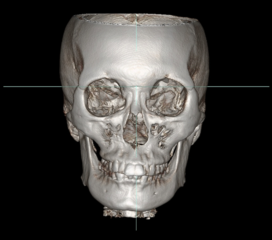英格下颌角手术CT前后对比