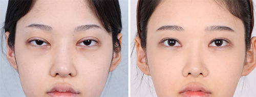 韩国soonplus双眼皮过宽修复眼提肌矫正前后对比案例