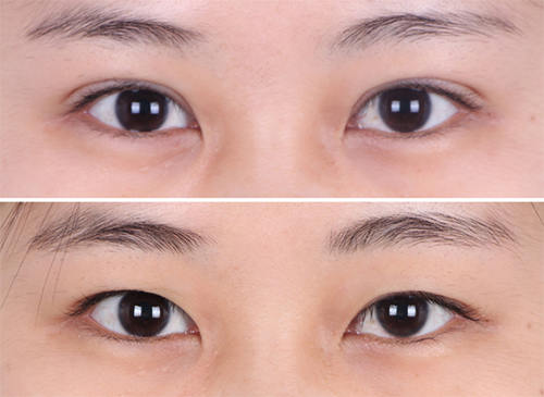 韩国soonplus双眼皮变单手术案例前后对比照片
