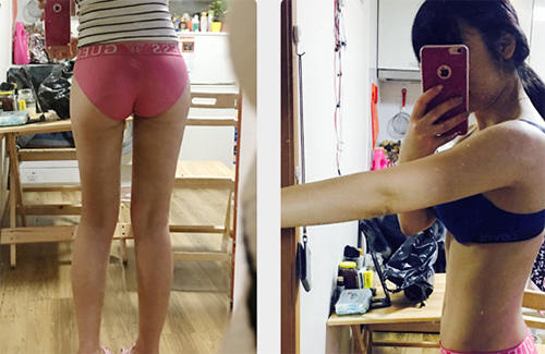 韩国维摩整形医院大腿吸脂对比图