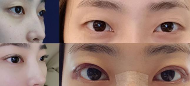 韩国纯真整形外科双眼皮案例