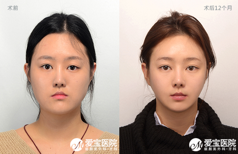韩国爱宝整形医院双鄂手术对比案例
