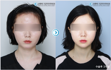韩国now美整口腔颌面外科对比案例