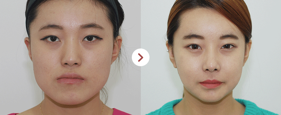 韩国now美整口腔颌面外科双鄂对比案例
