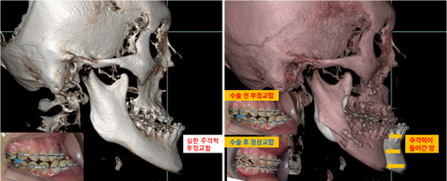韩国英格整形外科轮廓整形特点