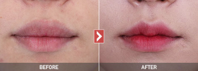 唇部整形手术方法有哪些，需要多少钱？