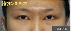 韩国内眼角修复对比
