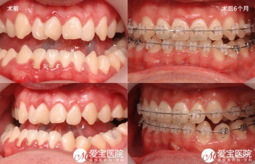 韩国爱宝整形医院地包天整形牙齿前后对比照片