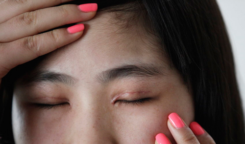 韩国贝缇莱茵整形双眼皮失败修复分析贴！