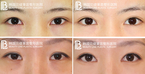 韩国贝缇莱茵医院双眼皮修复案例对比