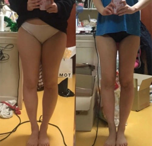 韩国美线整形外科大腿吸脂对比