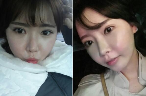 韩国A特整形医院双眼皮+颧骨缩小术后效果