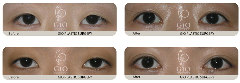 韩国gio整形外科双眼皮修复案例