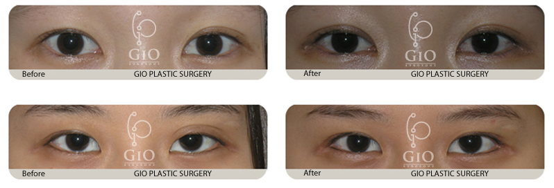 韩国gio整形外科双眼皮修复案例