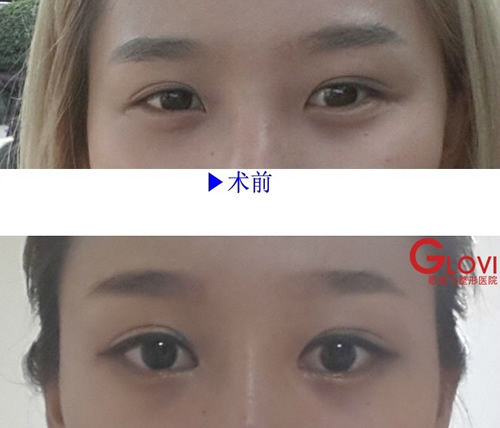韩国歌柔飞医院双眼皮案例对比