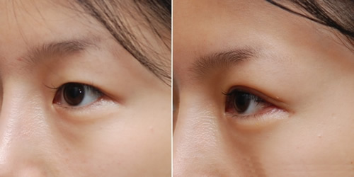韩国妩丽医院双眼皮手术日记