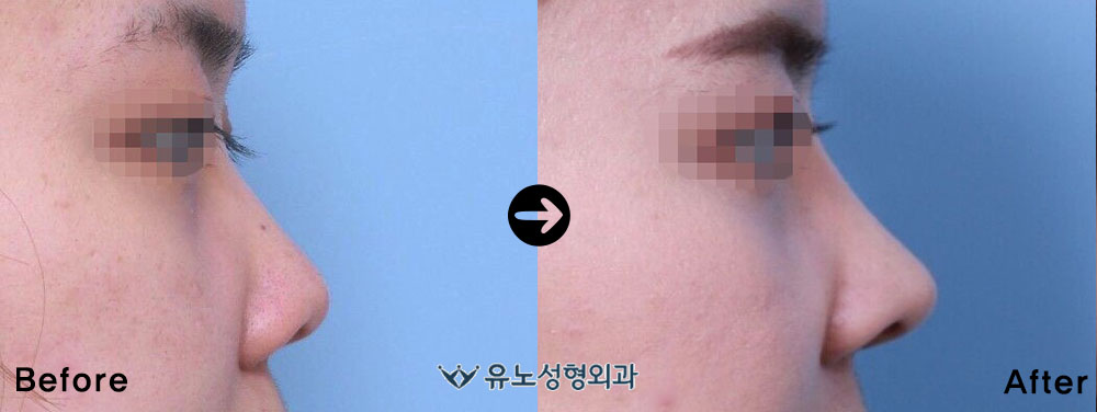 韩国朱诺鼻整形真人案例对比