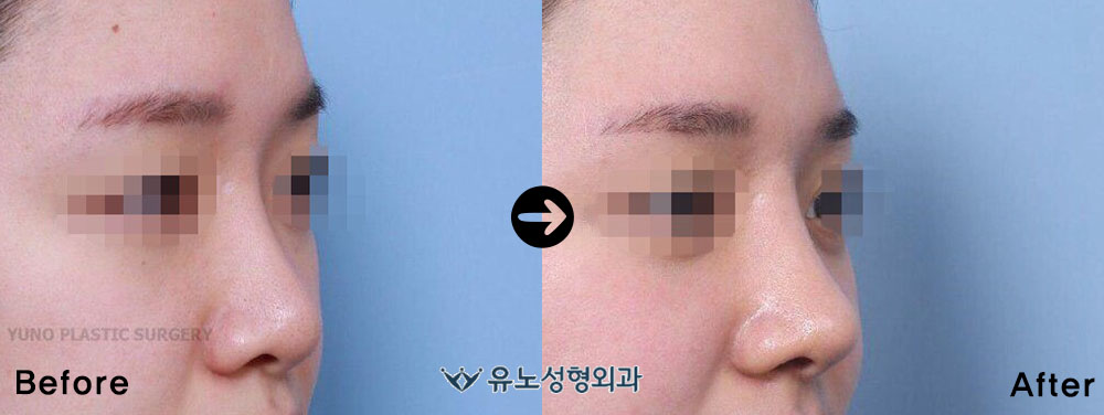 韩国朱诺整形网外科隆鼻案例