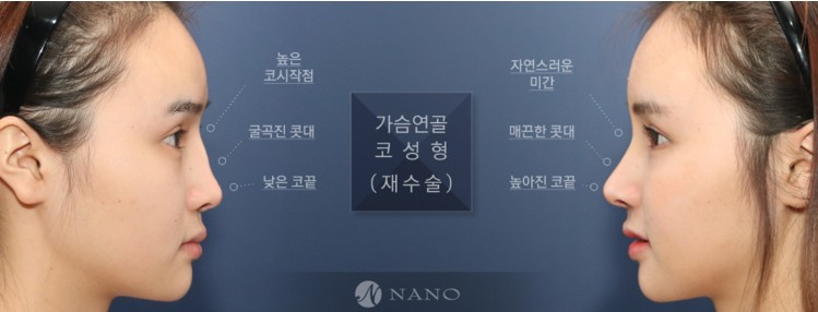 韩国nano整形外科隆鼻案例