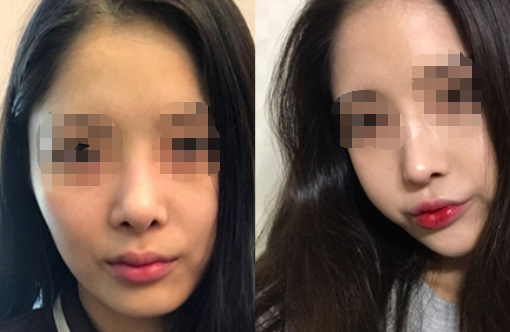 韩国丽丝塔整形外科隆鼻案例