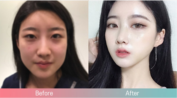 韩国普瑞美整形外科隆鼻案例