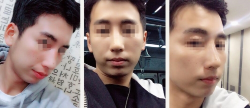 韩国普瑞美驼峰鼻矫术后照片