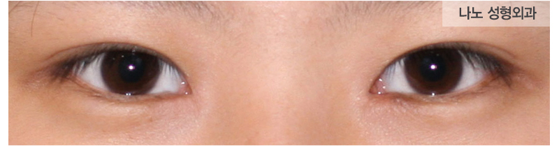 韩国nano双眼皮手术前后对比