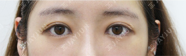 韩国jayjun整形外科双眼皮手术日记