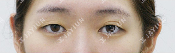 韩国jayjun双眼皮手术案例对比图