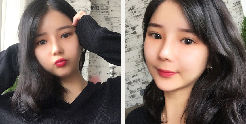 韩国普瑞美眼睛+鼻子+脂肪填充40天恢复日记案例展示